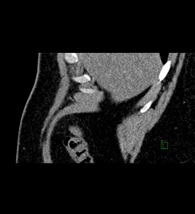 Chromophobe renal cell carcinoma (Radiopaedia 84286-99573 F 163).jpg