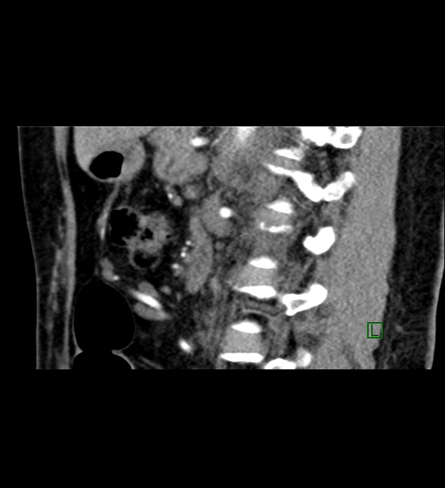 Chromophobe renal cell carcinoma (Radiopaedia 84290-99582 D 42).jpg