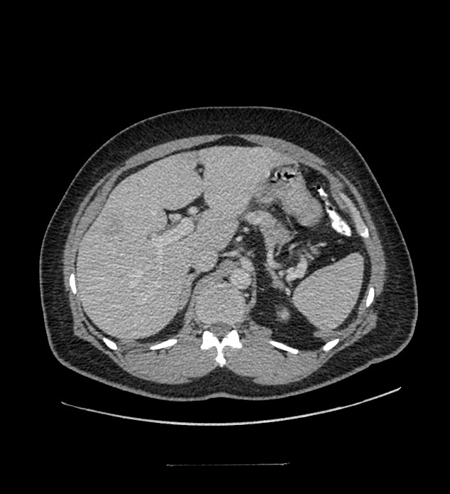 Chromophobe renal cell carcinoma (Radiopaedia 84337-99644 C 37).jpg