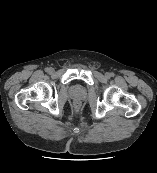 Chromophobe renal cell carcinoma (Radiopaedia 86879-103083 Axial non-contrast 132).jpg