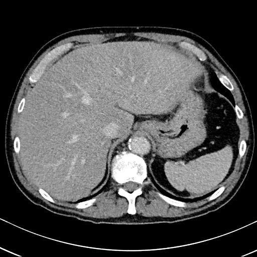 Chronic appendicitis complicated by appendicular abscess, pylephlebitis and liver abscess (Radiopaedia 54483-60700 B 36).jpg