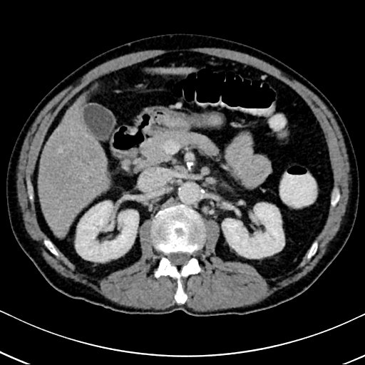 Chronic appendicitis complicated by appendicular abscess, pylephlebitis and liver abscess (Radiopaedia 54483-60700 B 60).jpg