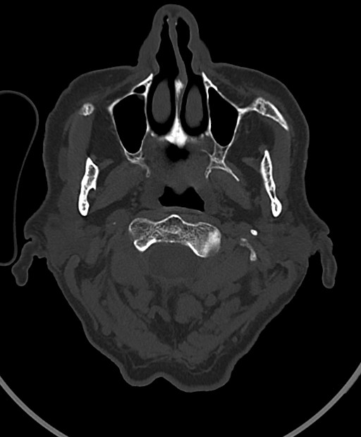 Chronic bilateral subdural hygroma (Radiopaedia 85801-101623 Axial bone window 119).jpg