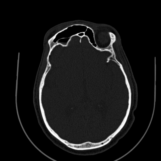 File:Chronic invasive fungal sinusitis (Radiopaedia 91563-109286 Axial sinus 127).jpg