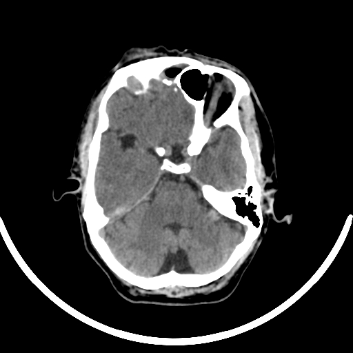 Chronic invasive fungal sinusitis with intraorbital and intracranial extension (Radiopaedia 56387-63046 Axial non-contrast 144).jpg