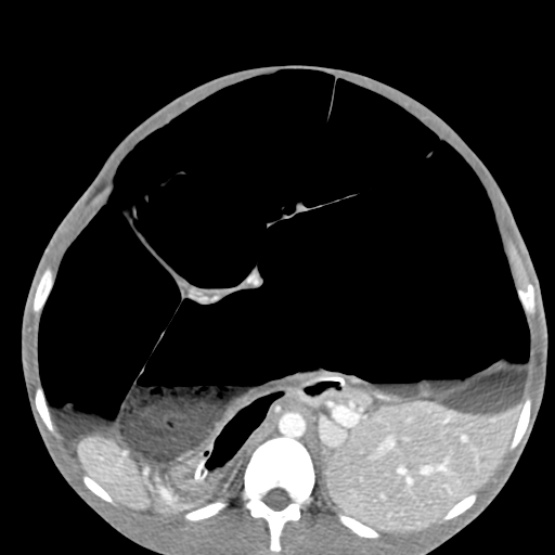Chronic large bowel pseudo-obstruction (Radiopaedia 43181-46492 A 70).jpg