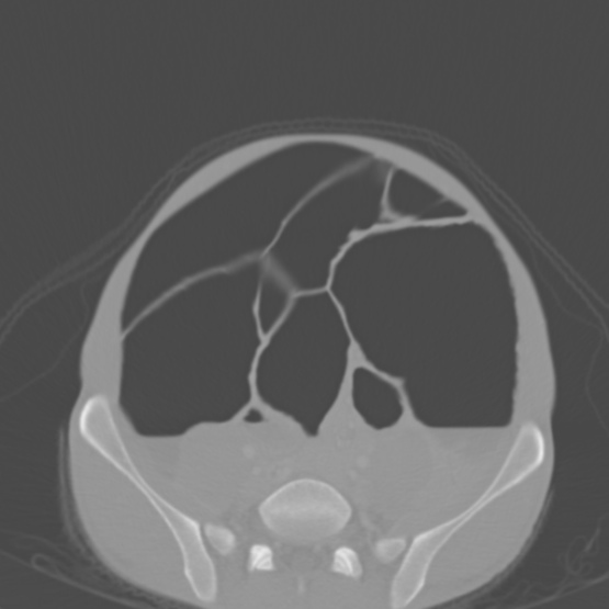 Chronic large bowel pseudo-obstruction (Radiopaedia 43181-46492 Axial bone window 125).jpg