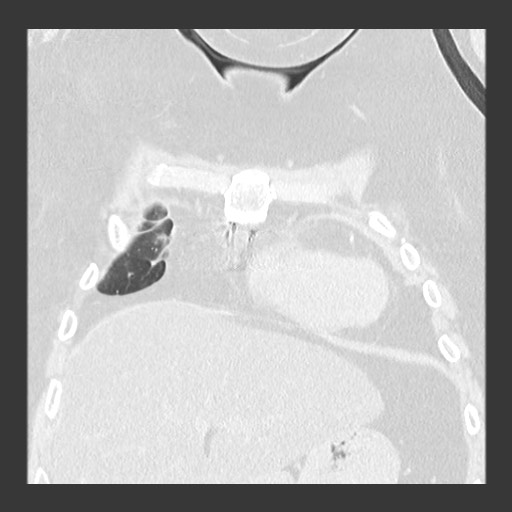 File:Chronic lung allograft dysfunction - restrictive form (Radiopaedia 60595-68316 Coronal lung window 29).jpg