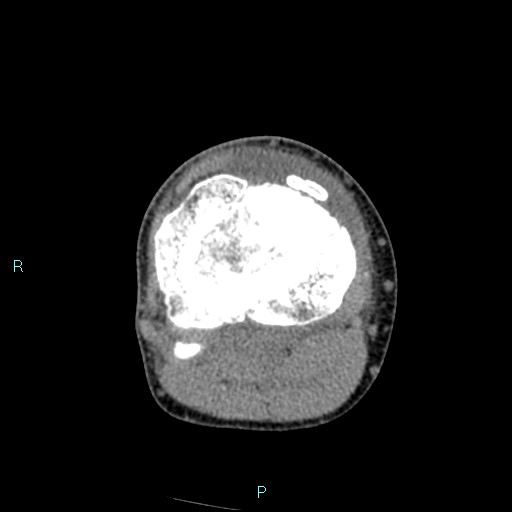 Chronic osteomyelitis (with Brodie abscess) (Radiopaedia 76405-88111 A 93).jpg