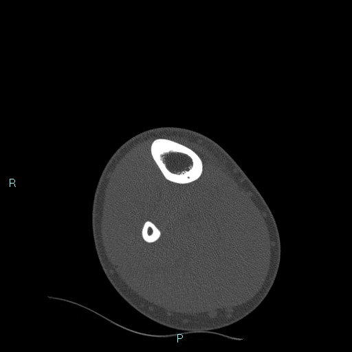 File:Chronic osteomyelitis (with Brodie abscess) (Radiopaedia 76405-88111 Axial bone window 2).jpg