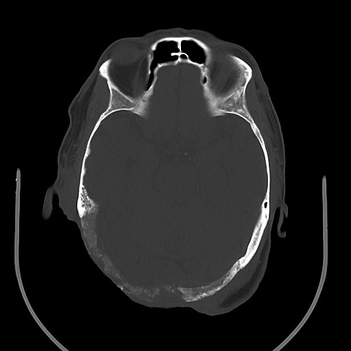 Chronic osteomyelitis - calvarial (severe) (Radiopaedia 69668-79616 Axial bone window 39).jpg