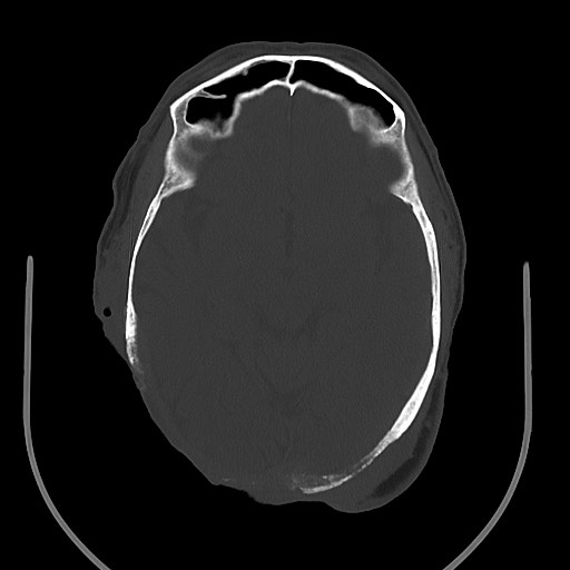 Chronic osteomyelitis - calvarial (severe) (Radiopaedia 69668-79616 Axial bone window 42).jpg