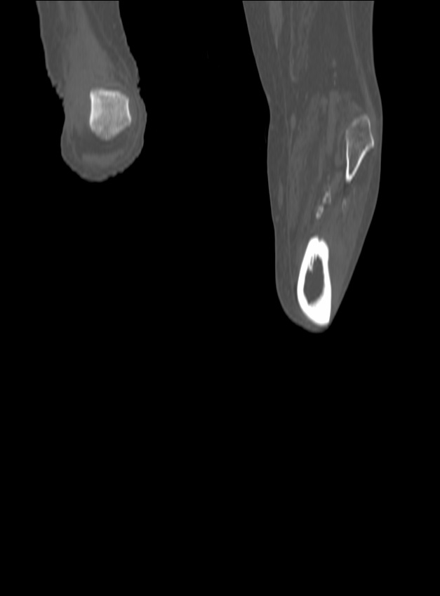 Chronic osteomyelitis - tibia (with sequestrum) (Radiopaedia 73273-84090 Coronal non-contrast 76).jpg
