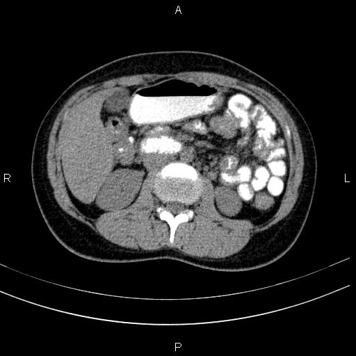 File:Chronic pancreatitis (Radiopaedia 64576-73450 Axial non-contrast 70).jpg