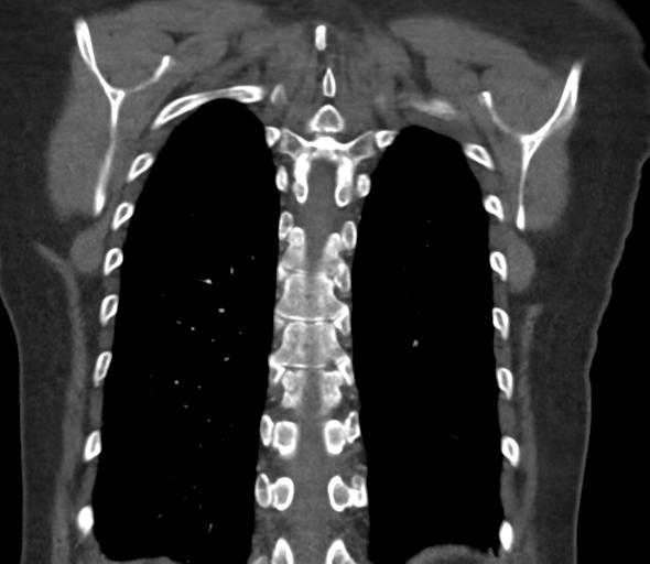 File:Chronic pulmonary embolus (Radiopaedia 39129-41341 Coronal C+ CTPA 68).png