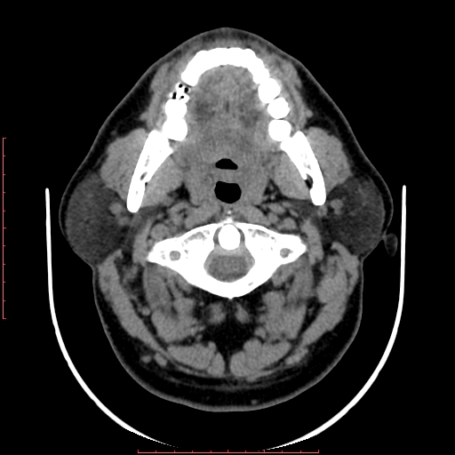 Chronic submandibular sialolithiasis (Radiopaedia 69817-79814 Axial non-contrast 66).jpg
