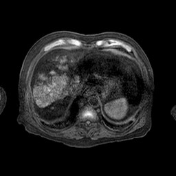 Cirrhosis and hepatocellular carcinoma in the setting of hemochromatosis (Radiopaedia 75394-86594 Axial T1 C+ fat sat 62).jpg