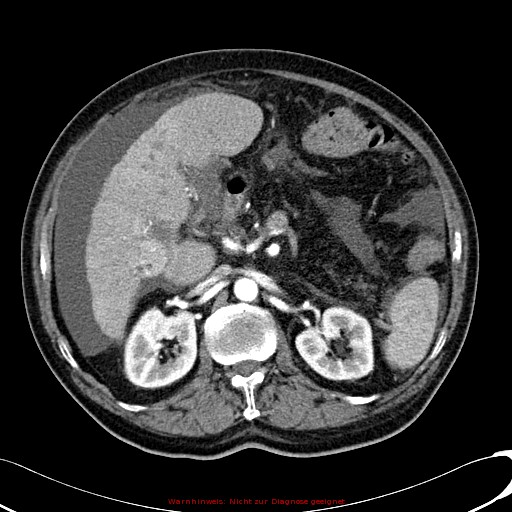 File:Cirrhosis and hepatocellular carcinoma in the setting of hemochromatosis (Radiopaedia 75394-86595 A 36).jpg