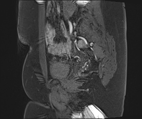 File:Class II Mullerian duct anomaly- unicornuate uterus with rudimentary horn and non-communicating cavity (Radiopaedia 39441-41755 G 26).jpg