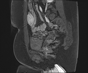 File:Class II Mullerian duct anomaly- unicornuate uterus with rudimentary horn and non-communicating cavity (Radiopaedia 39441-41755 G 35).jpg