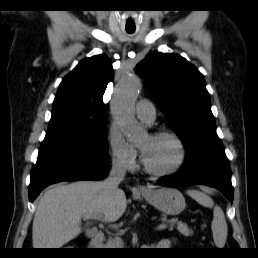 File:Classic complicated silicosis (Radiopaedia 49720-54961 Coronal liver window 23).jpg