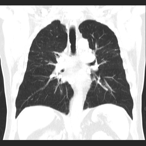 File:Classic complicated silicosis (Radiopaedia 49720-54961 Coronal lung window 35).jpg