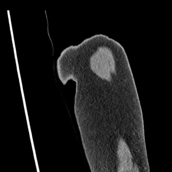 Clear cell chondrosarcoma - humerus (Radiopaedia 63104-71612 Coronal non-contrast 3).jpg