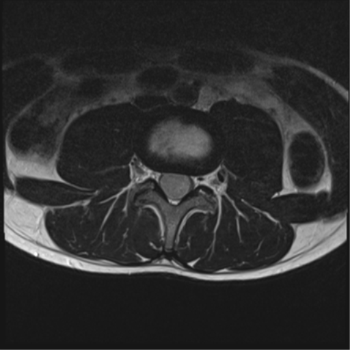 File:Clear cell meningoma - lumbar spine (Radiopaedia 60116-67690 Axial T2 19).png