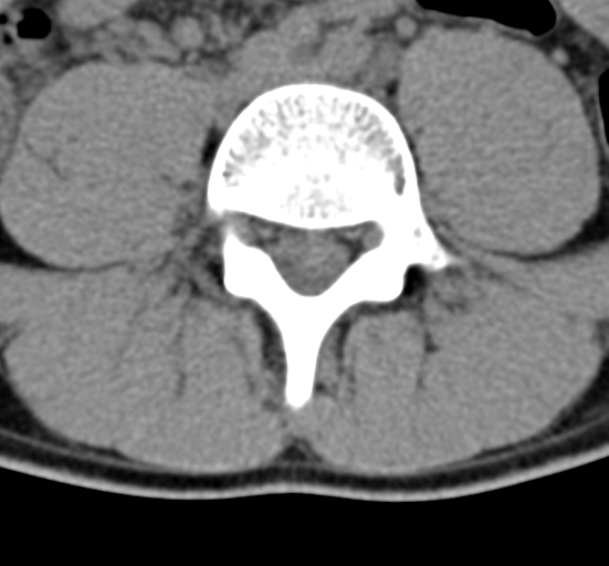 File:Clear cell meningoma - lumbar spine (Radiopaedia 60116-67691 Axial non-contrast 51).png