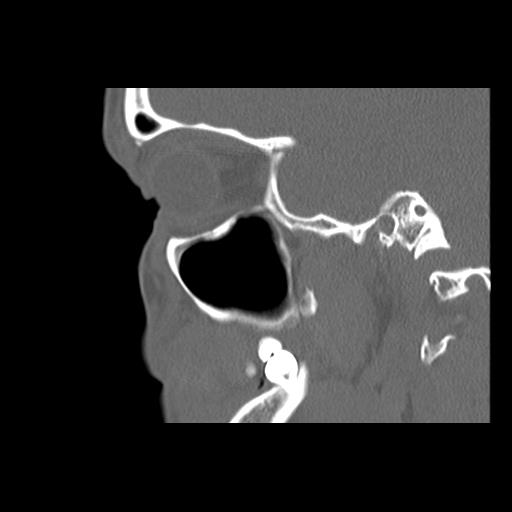 Cleft hard palate and alveolus (Radiopaedia 63180-71710 Sagittal bone window 17).jpg