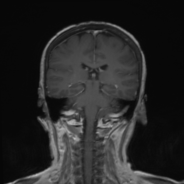 File:Clival meningioma (Radiopaedia 53278-59248 F 18).jpg