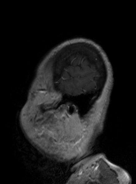 File:Clival meningioma (Radiopaedia 53278-59248 Sagittal T1 C+ 140).jpg