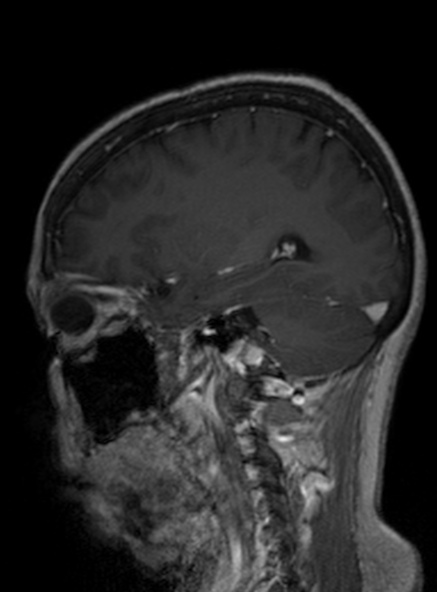 Clival meningioma (Radiopaedia 53278-59248 Sagittal T1 C+ 206).jpg