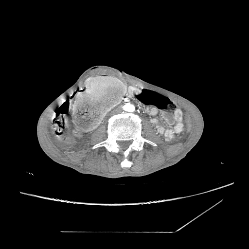 Closed-loop obstruction due to peritoneal seeding mimicking internal hernia after total gastrectomy (Radiopaedia 81897-95864 A 116).jpg