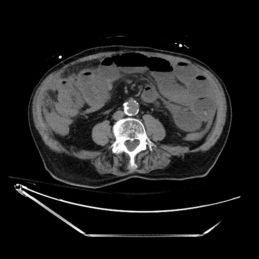 File:Closed loop obstruction due to adhesive band, resulting in small bowel ischemia and resection (Radiopaedia 83835-99023 Axial non-contrast 88).jpg