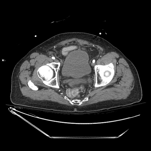 File:Closed loop obstruction due to adhesive band, resulting in small bowel ischemia and resection (Radiopaedia 83835-99023 B 140).jpg