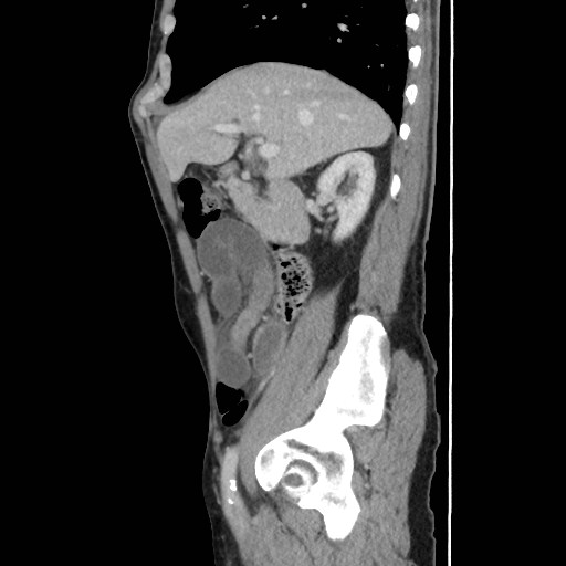 File:Closed loop small bowel obstruction (Radiopaedia 59227-66554 C 21).jpg