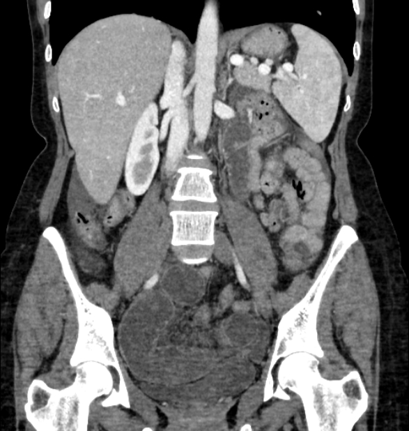Closed loop small bowel obstruction (Radiopaedia 71211-81508 B 68).jpg