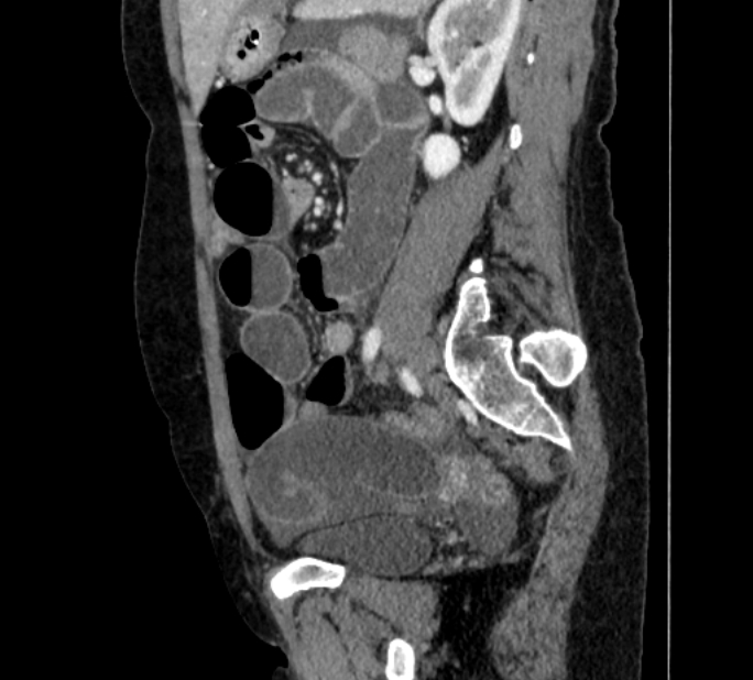 Closed loop small bowel obstruction (Radiopaedia 71211-81508 C 104).jpg