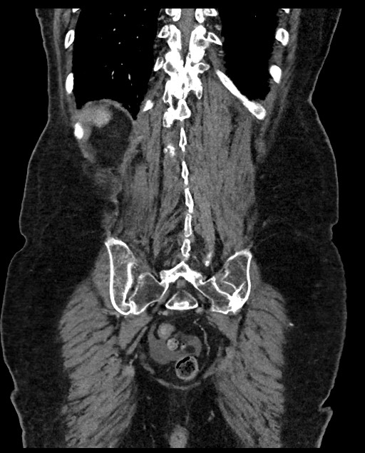 Closed loop small bowel obstruction - adhesions (Radiopaedia 59269-66611 B 104).jpg