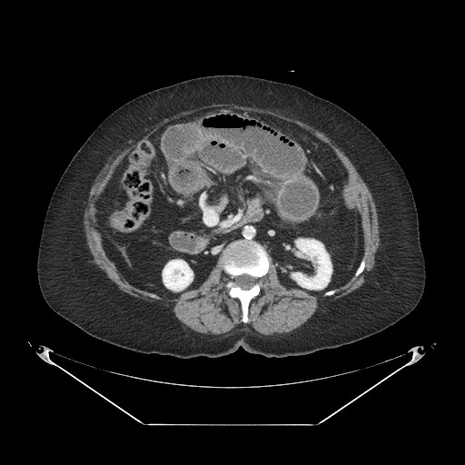 Closed loop small bowel obstruction - internal hernia (Radiopaedia 65402-74450 A 56).jpg