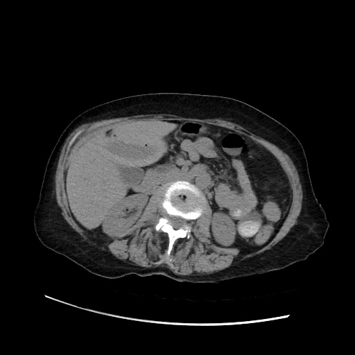 File:Closed loop small bowel obstruction due to adhesive band, with intramural hemorrhage and ischemia (Radiopaedia 83831-99017 Axial non-contrast 71).jpg