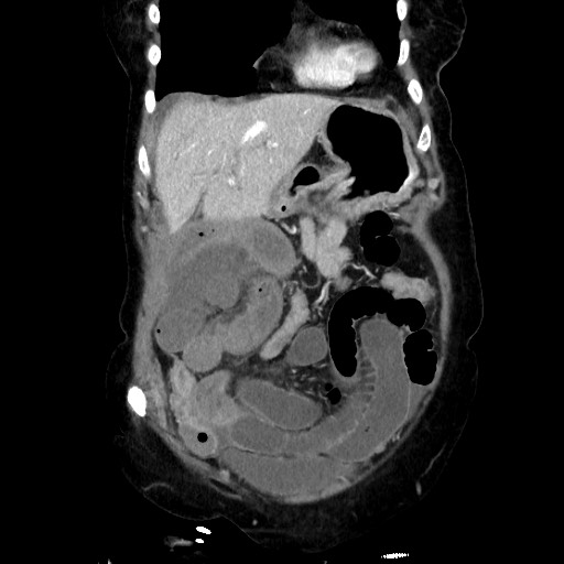 Closed loop small bowel obstruction due to adhesive band, with intramural hemorrhage and ischemia (Radiopaedia 83831-99017 C 35).jpg