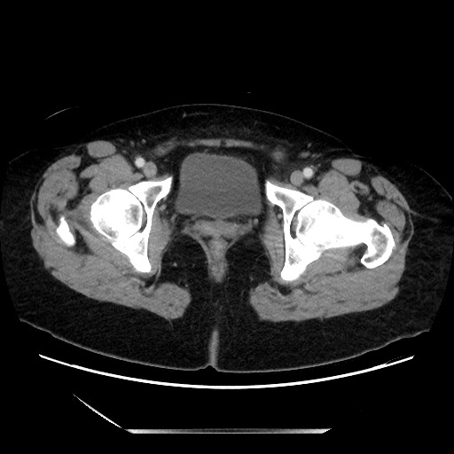 Closed loop small bowel obstruction due to adhesive bands - early and late images (Radiopaedia 83830-99014 A 151).jpg