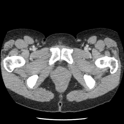 Closed loop small bowel obstruction due to trans-omental herniation (Radiopaedia 35593-37109 A 88).jpg
