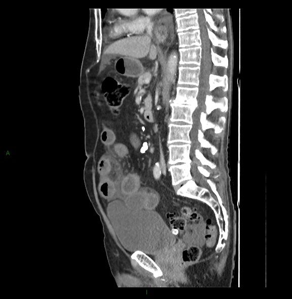 Closed loop small bowel obstruction with ischemia (Radiopaedia 84180-99456 C 46).jpg