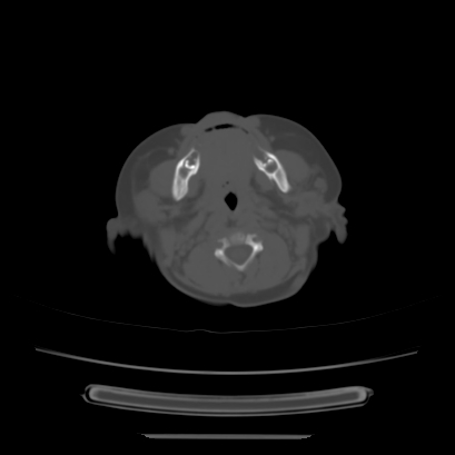 Cloverleaf skull (Radiopaedia 91901-109710 Axial bone window 30).jpg