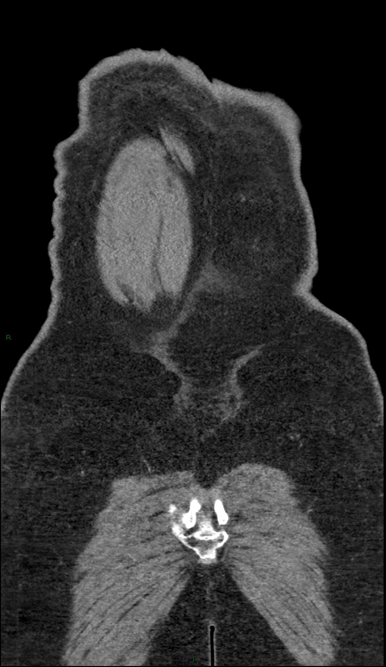 Coarctation of the aorta (Radiopaedia 74632-88521 B 257).jpg