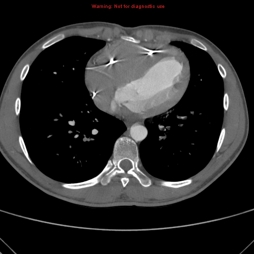 File:Coarctation of the aorta (Radiopaedia 9434-10118 A 129).jpg