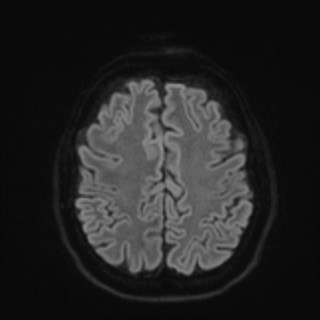 Cochlear incomplete partition type III associated with hypothalamic hamartoma (Radiopaedia 88756-105498 Axial DWI 70).jpg